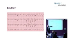 Simple Education : Essential Guide to electrocardiogram (ECG) interpretation (Videos)