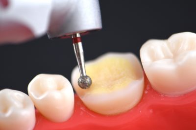 The Baard Institute Overlay, Onlay, & Advanced Adhesion
