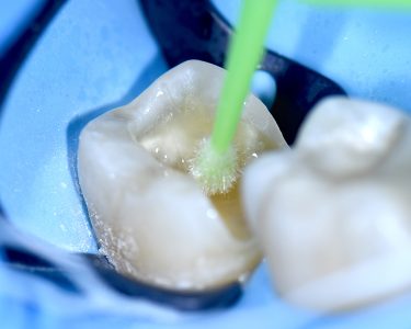 The Baard Institute Overlay, Onlay, & Advanced Adhesion