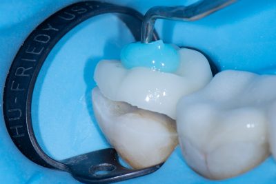 The Baard Institute Overlay, Onlay, & Advanced Adhesion
