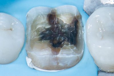 The Baard Institute Overlay, Onlay, & Advanced Adhesion