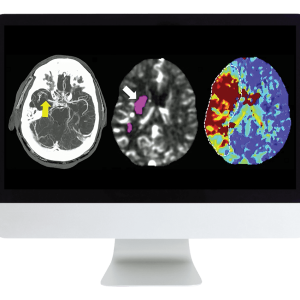 ARRS Code Stroke: What Every Radiologist Should Know 2022