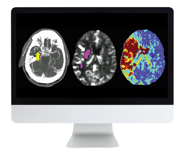 ARRS Code Stroke: What Every Radiologist Should Know 2022