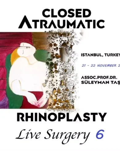 Closed Atraumatic Rhinoplasty Live Surgery DVD 6