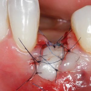 Gidedental Soft Tissue Management around Natural Teeth and Dental Implants 2020 (CME VIDEOS)