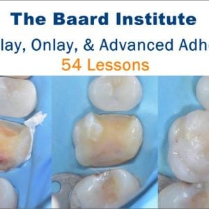 The Baard Institute Overlay, Onlay, & Advanced Adhesion