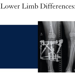 Managing Children with Lower Limb Differences: An Integrated Approach 2022