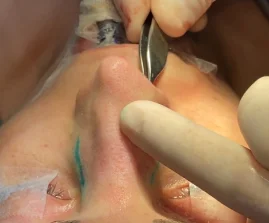 Perface Secundary Rhino