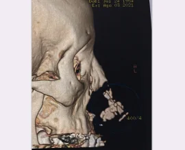 Perface Secundary Rhino