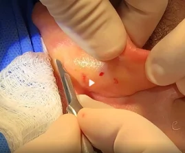 Perface Secundary Rhino
