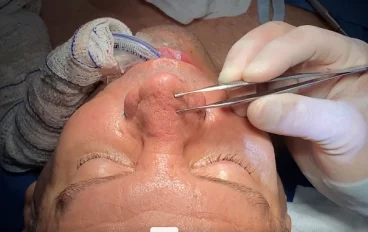 Perface Secundary Rhino