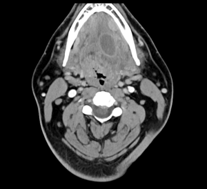 MRIOnline Imaging Mastery Series: Pathology of the Oral Cavity and Oropharynx 2020 (CME VIDEOS)