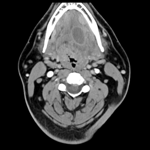 MRIOnline Imaging Mastery Series: Pathology of the Oral Cavity and Oropharynx 2020 (CME VIDEOS)