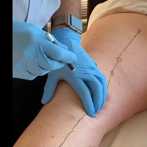 Lyftogt Perineural Injection Treatment videos: Knee collection