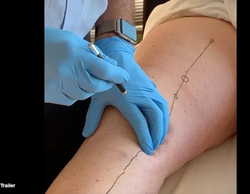 Lyftogt Perineural Injection Treatment videos: Knee collection