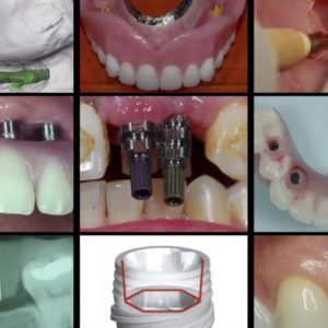 Gidedental A-Z in Restorative Implant Dentistry (CME VIDEOS)