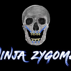 Ninja Zygoma – Implant Ninja