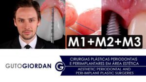 Aesthetic Periodontal and Peri-Implant Plastic Surgeries Portugase with English