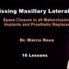 Missing Maxillary Lateral Incisors: Space Closure in all Malocclusions vs Implants and Prosthetic Replacement