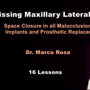 Missing Maxillary Lateral Incisors: Space Closure in all Malocclusions vs Implants and Prosthetic Replacement