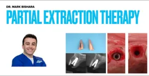 Partial Extraction Therapy Course