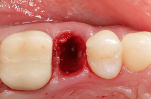 Gidedental Extraction Socket – Preservation/Grafting; Immediate vs Delayed Implants; Pontic Site Development 2020 (CME VIDEOS)