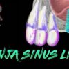 Ninja Sinus Lift Course