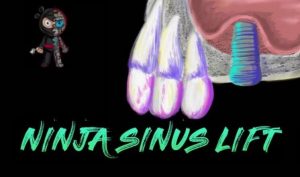 Ninja Sinus Lift Course