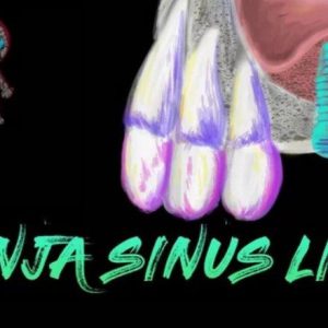 Ninja Sinus Lift Course