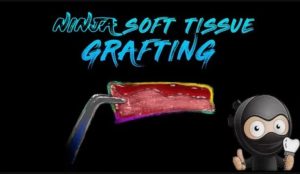 Ninja Soft Tissue Grafting