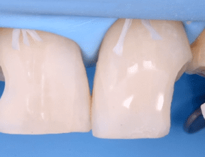 Gidedental Direct and Indirect Adhesive Restorations – Minimal Invasive Treatment of the Anterior and Posterior Damaged Dentition using Direct Bonded Restorations 2020 (CME VIDEOS)