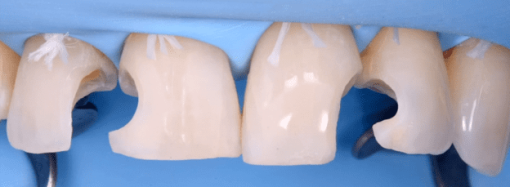 Gidedental Direct and Indirect Adhesive Restorations – Minimal Invasive Treatment of the Anterior and Posterior Damaged Dentition using Direct Bonded Restorations 2020 (CME VIDEOS)