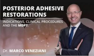 Osteocom Posterior Adhesive Restorations: Indications, Clinical Procedures and mDPT Techniques / Marco Veneziani