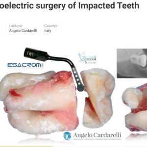 Piezoelectric Surgery of Impacted Teeth 2021 By: Angelo Cardarelli