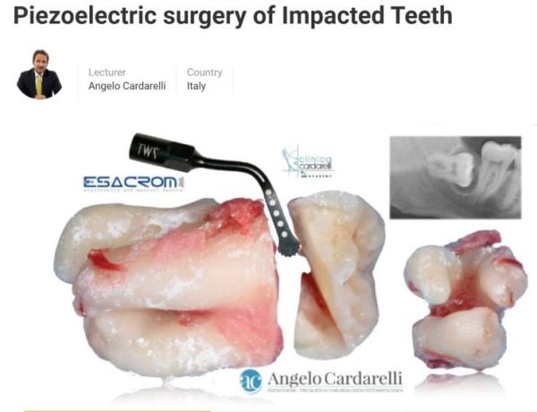 Piezoelectric Surgery of Impacted Teeth 2021 By: Angelo Cardarelli