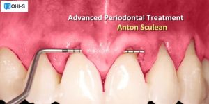 OHI-S Advanced Periodontal Treatment – Anton Sculean