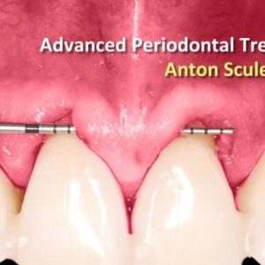 OHI-S Advanced Periodontal Treatment – Anton Sculean