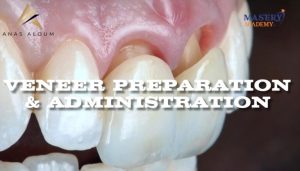 Mastery Academy Veneer Preparation and Administration – Anas Aloum