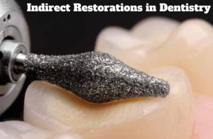 Indirect Restorations in Dentistry – A Complete Guide