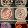 3D Ultrasound in prenatal diagnosis by Rabih Chaoui 2nd edition original PDF 2024