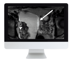 ARRS Pitfalls in GI Imaging 2022