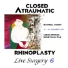 Closed Atraumatic Rhinoplasty Live Surgery DVD 6