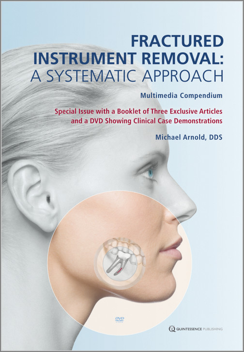 Fractured Instrument Removal: A Systematic Approach Indirect Restorations in Dentistry – A Complete GuideFractured Instrument Removal: A Systematic Approach