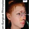 Non-Surgical Rhinoplasty (The PRIME Series) (pdf)