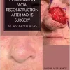 Combination Facial Reconstruction after Mohs Surgery ( pdf )