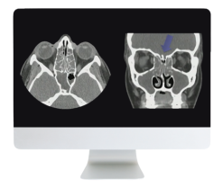 ARRS Cranial Nerve Imaging: From the Least to the Last 2022 ( Videos + CME Questions)
