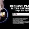 OHI-S Implant Placement in the Aesthetic Zone: Steps and Technique