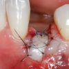 Gidedental Soft Tissue Management around Natural Teeth and Dental Implants 2020