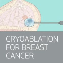 Houston Methodist Cryoablation for Breast Cancer 2023