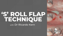 The S Roll Flap Technique